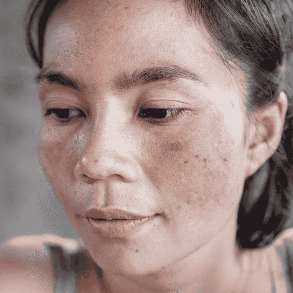 Melasma