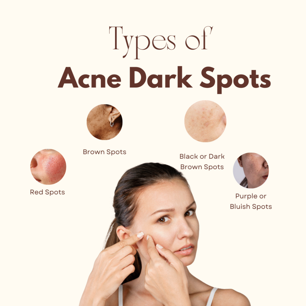 Types of Acne Dark Spots