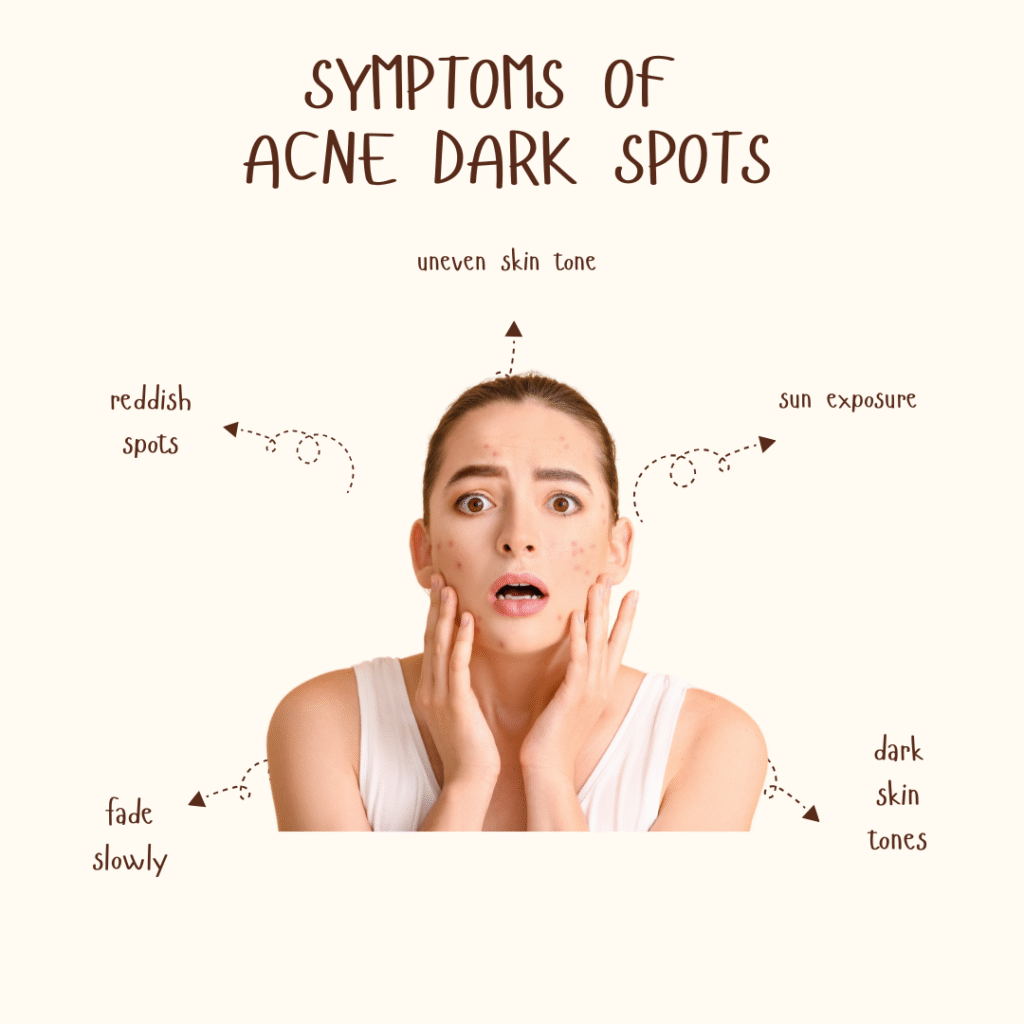 Symptoms of Acne Dark Spots