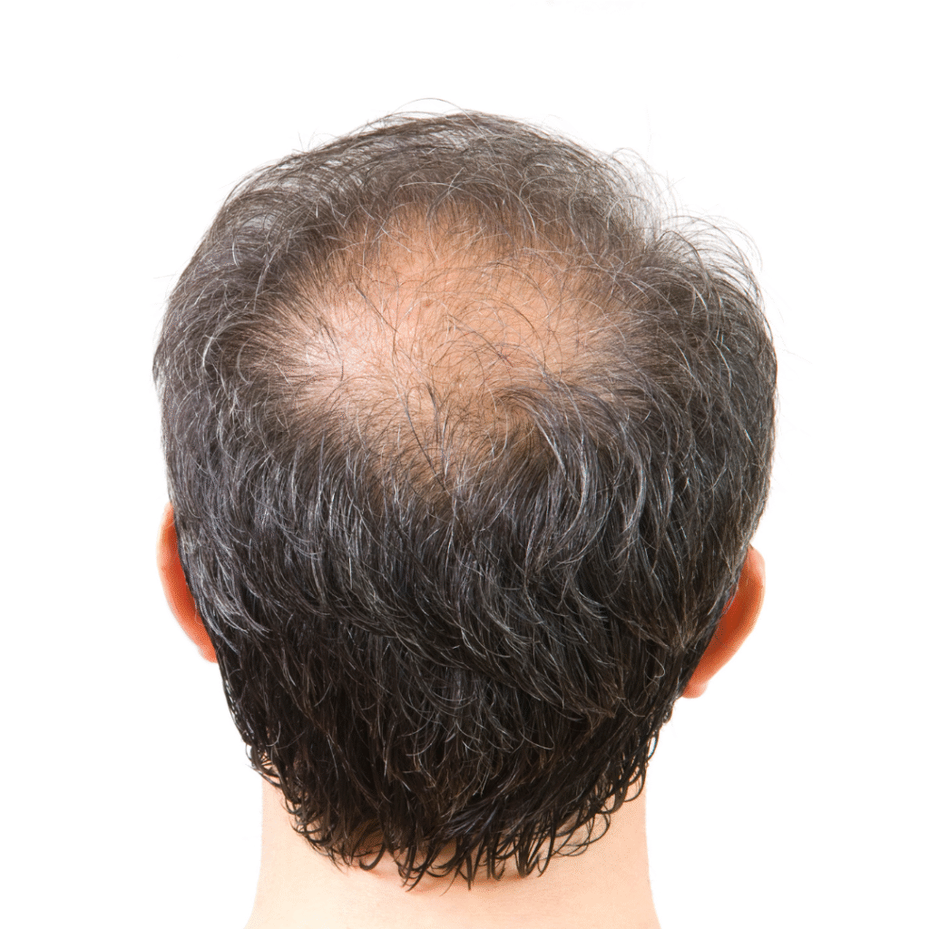 Male Pattern Baldness treatment