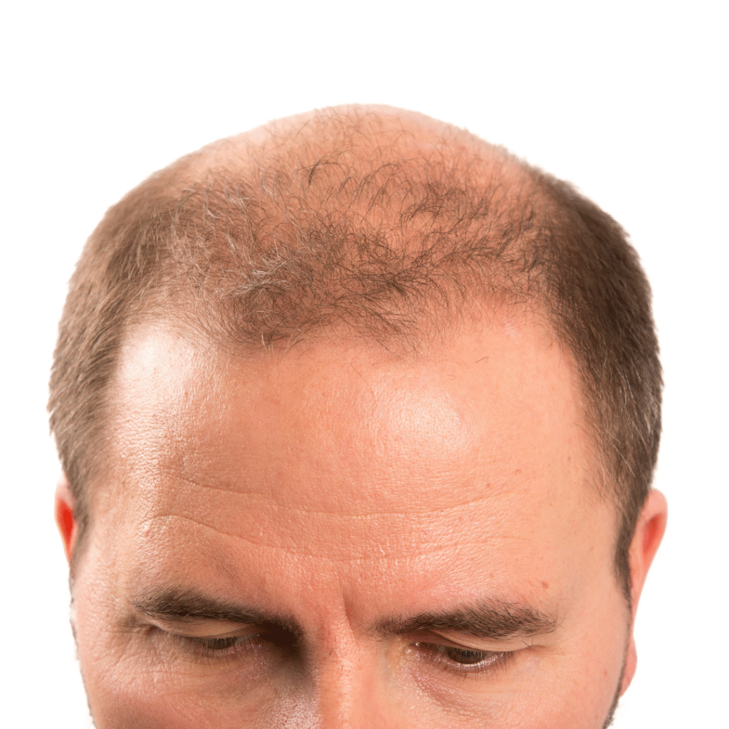 Male Pattern Baldness treatment