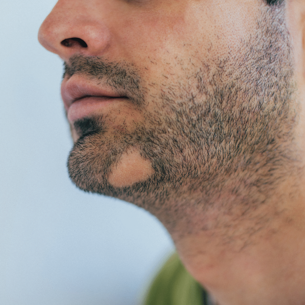 Alopecia Areata treatment