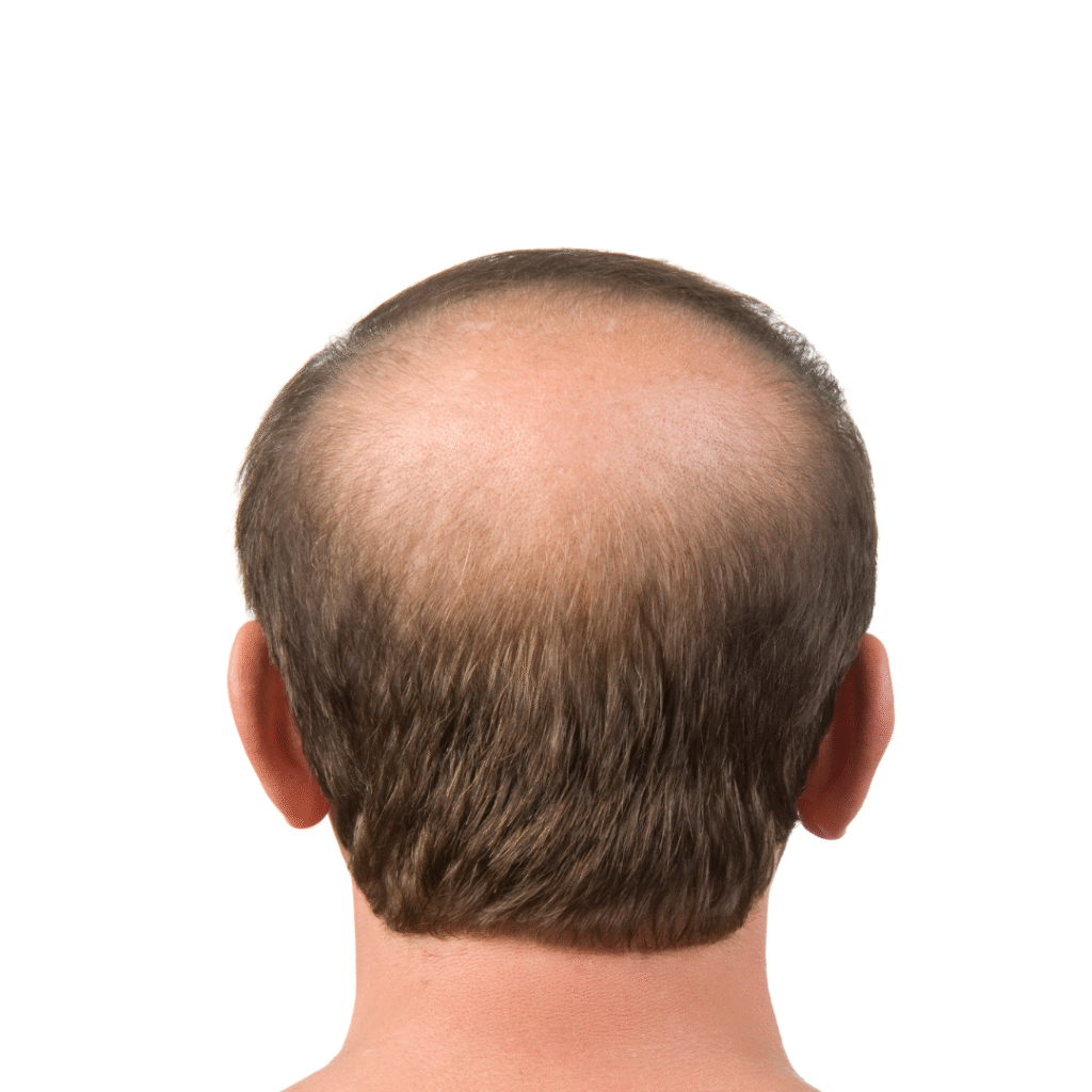 Male Pattern Baldness treatment