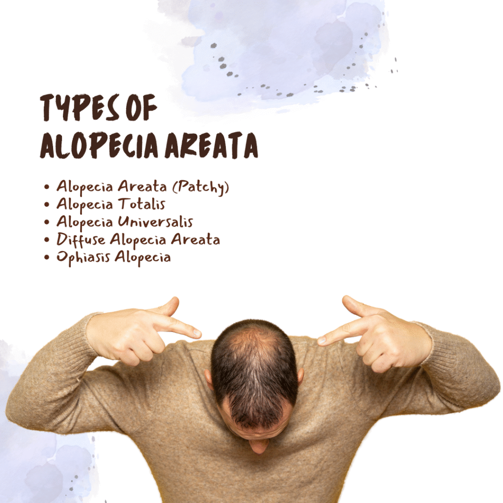 Alopecia Areata treatment