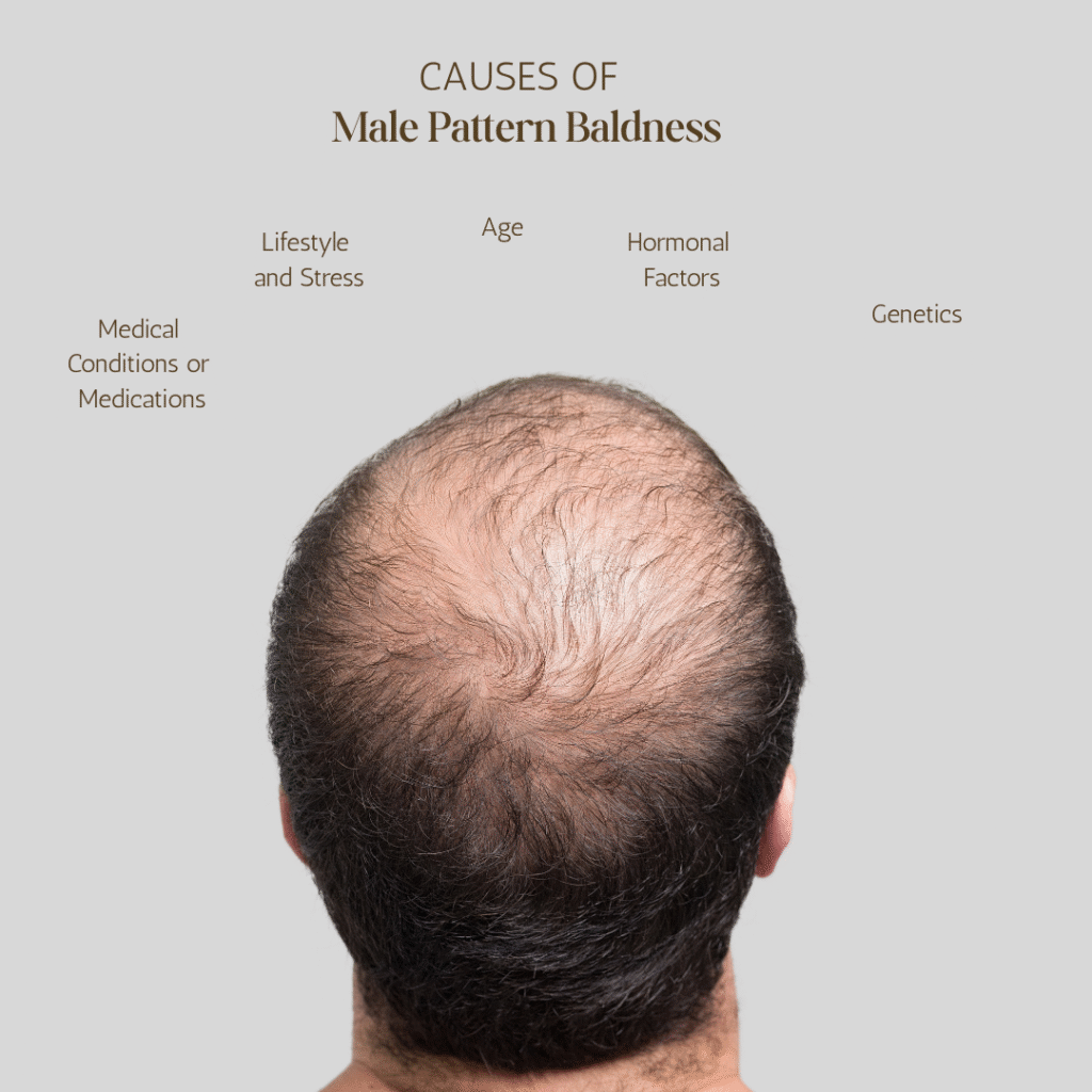 Male Pattern Baldness treatment