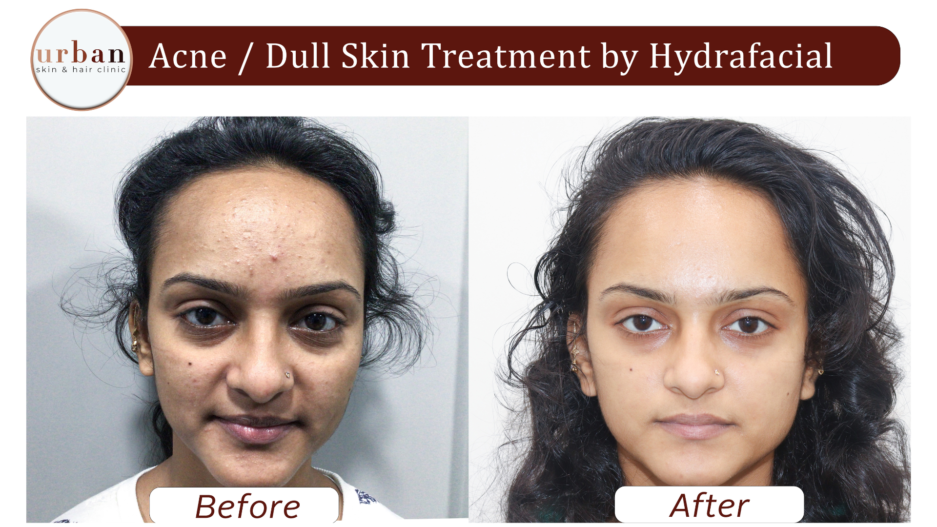 Acne Dull Skin treatment by hydrafacial