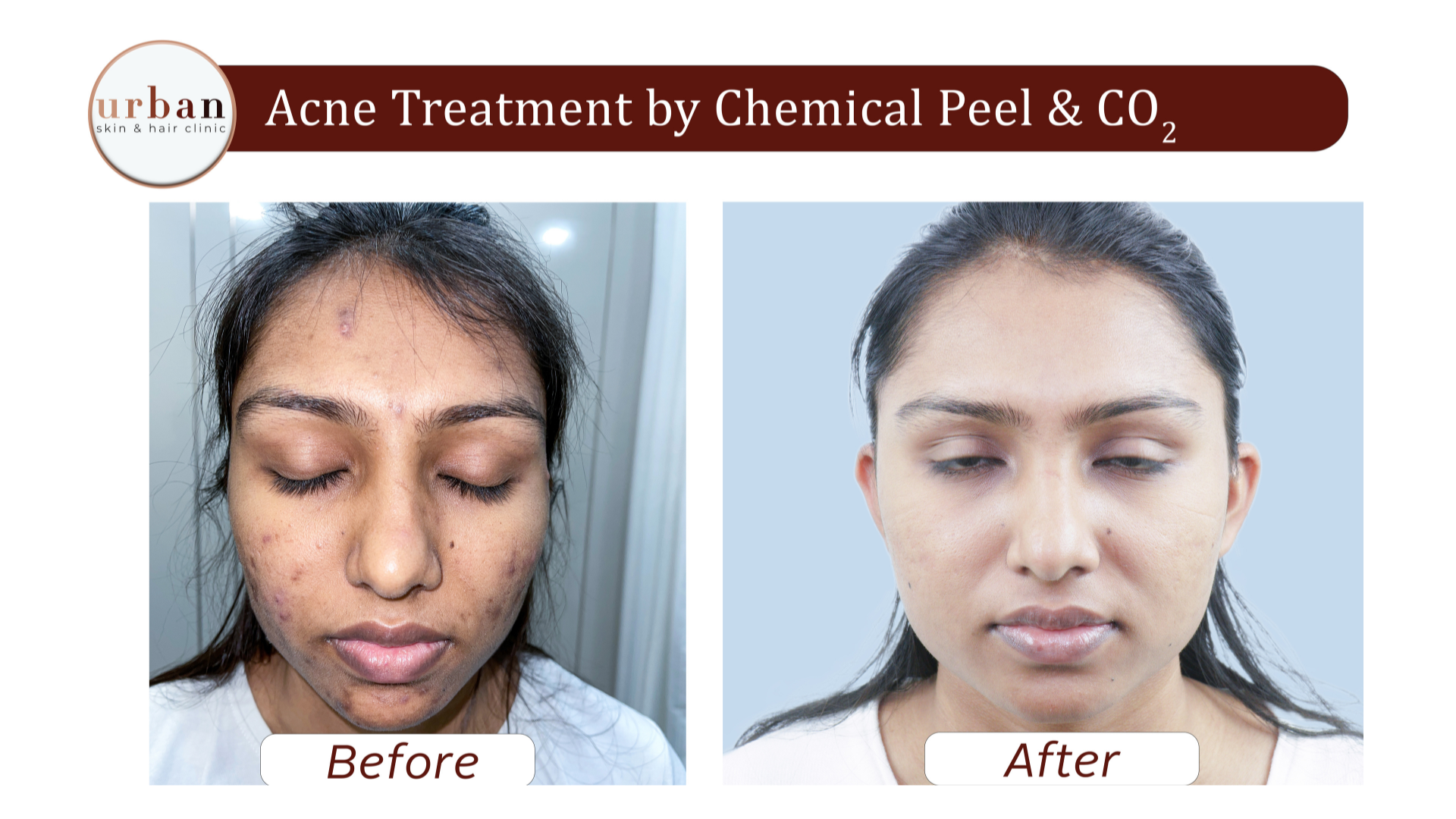 Acne treatment by Chemichal peel & CO2 1