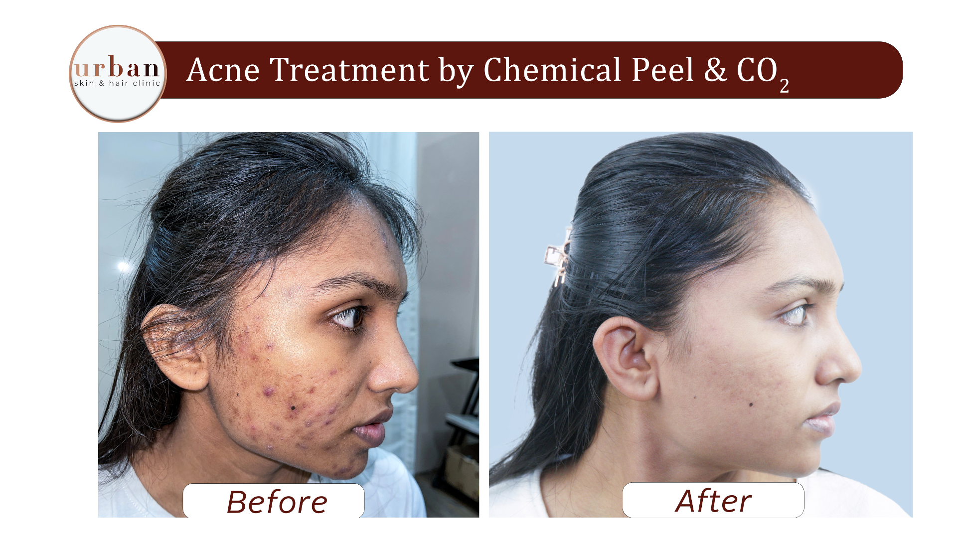 Acne treatment by Chemichal peel & CO2 2