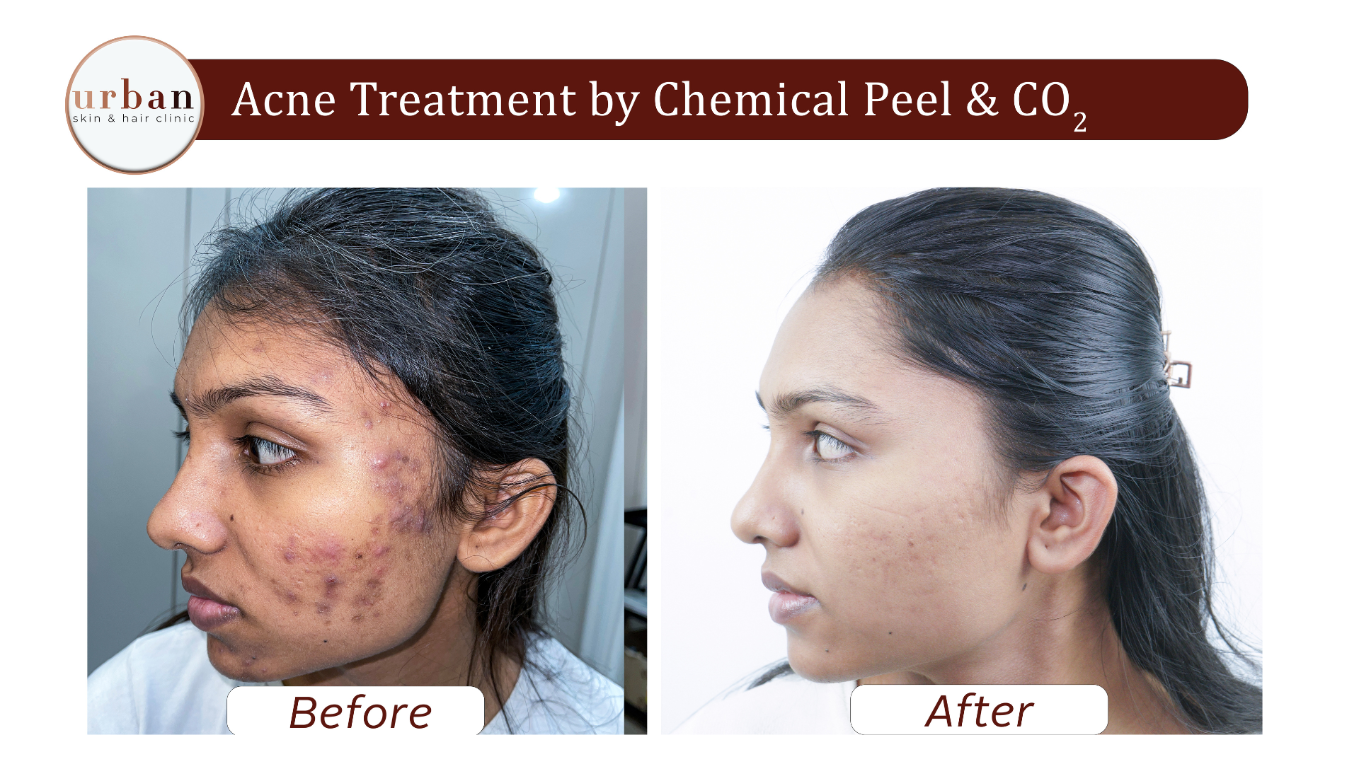Acne treatment by Chemichal peel & CO2
