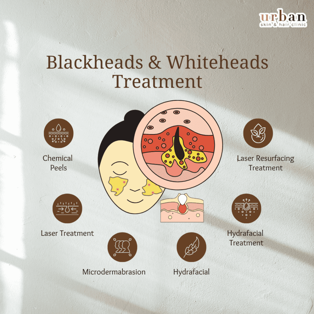 blackheads treatment