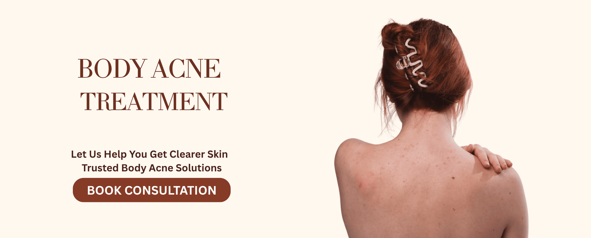 Body acne treatment