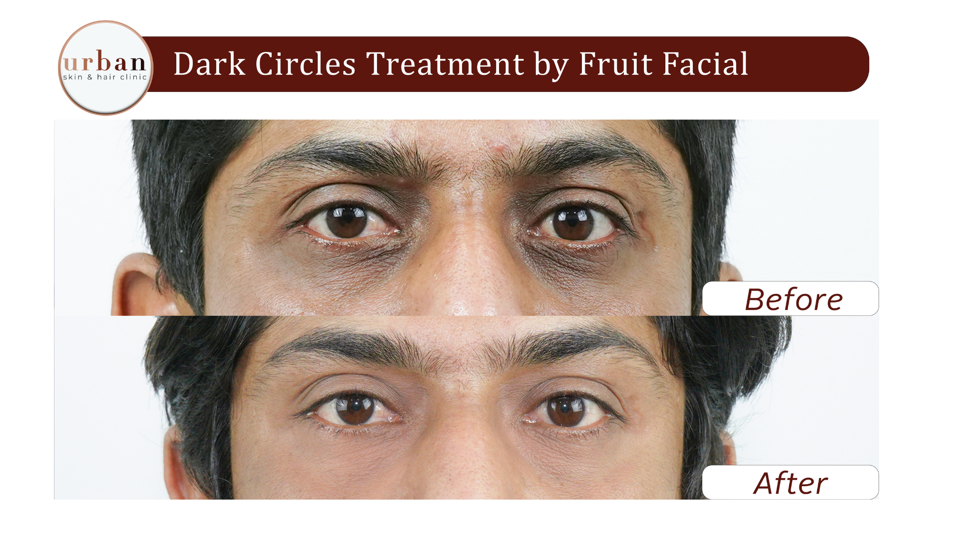 Dark circle fruit facial