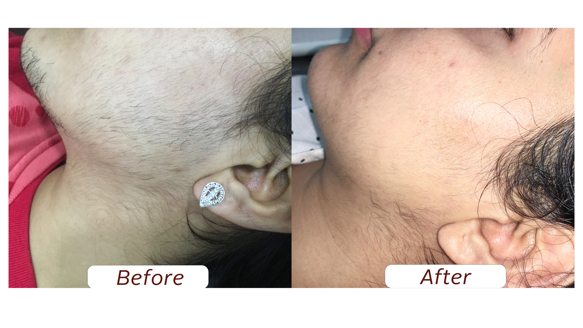 Facial Hair removal 1