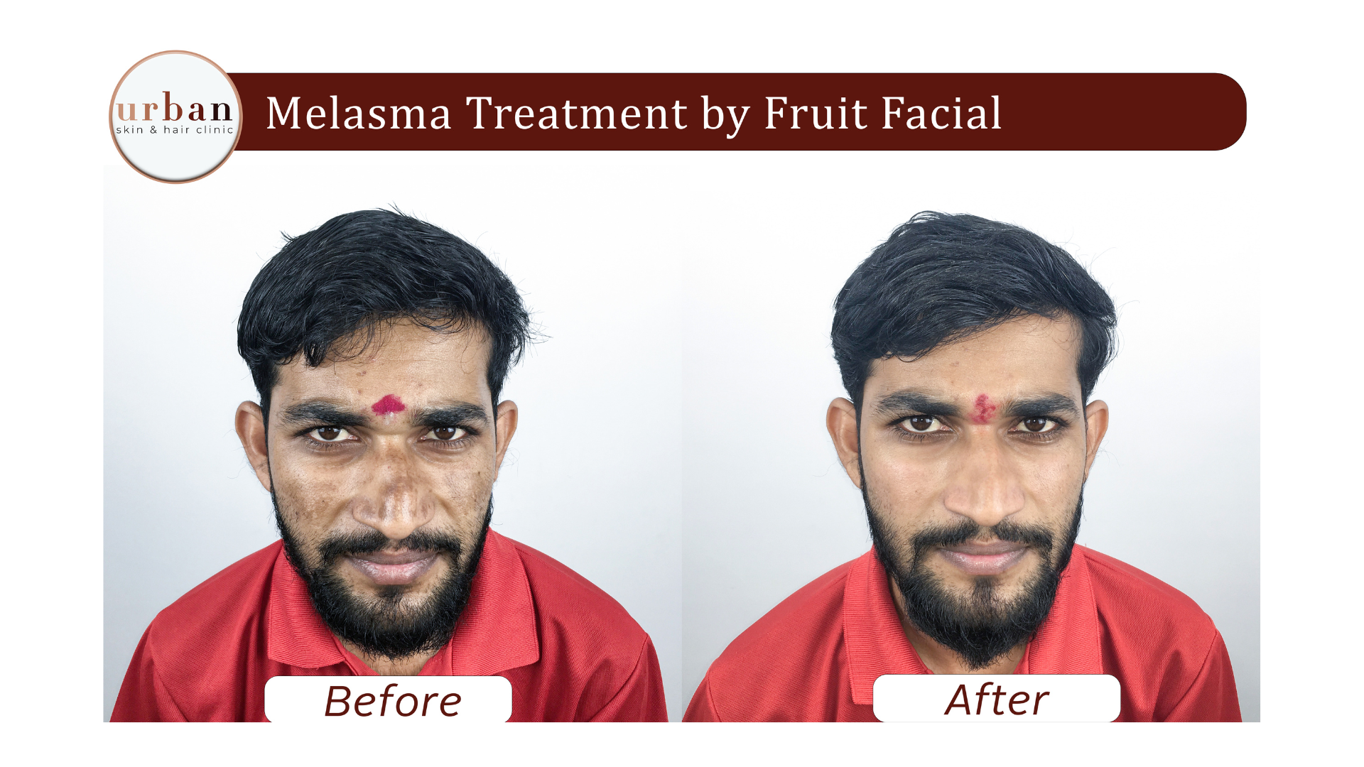 Melasma treatment By Fruit Facial