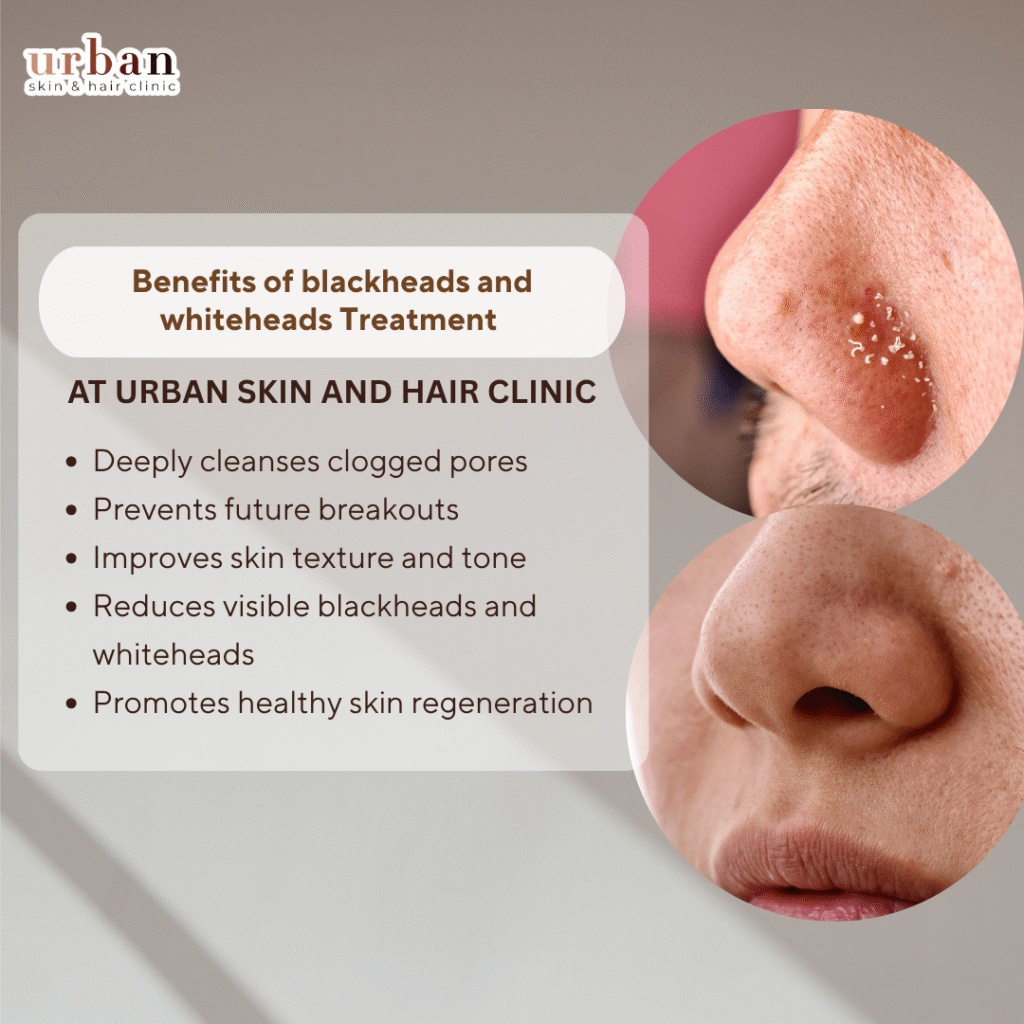 blackheads and white heads treatment