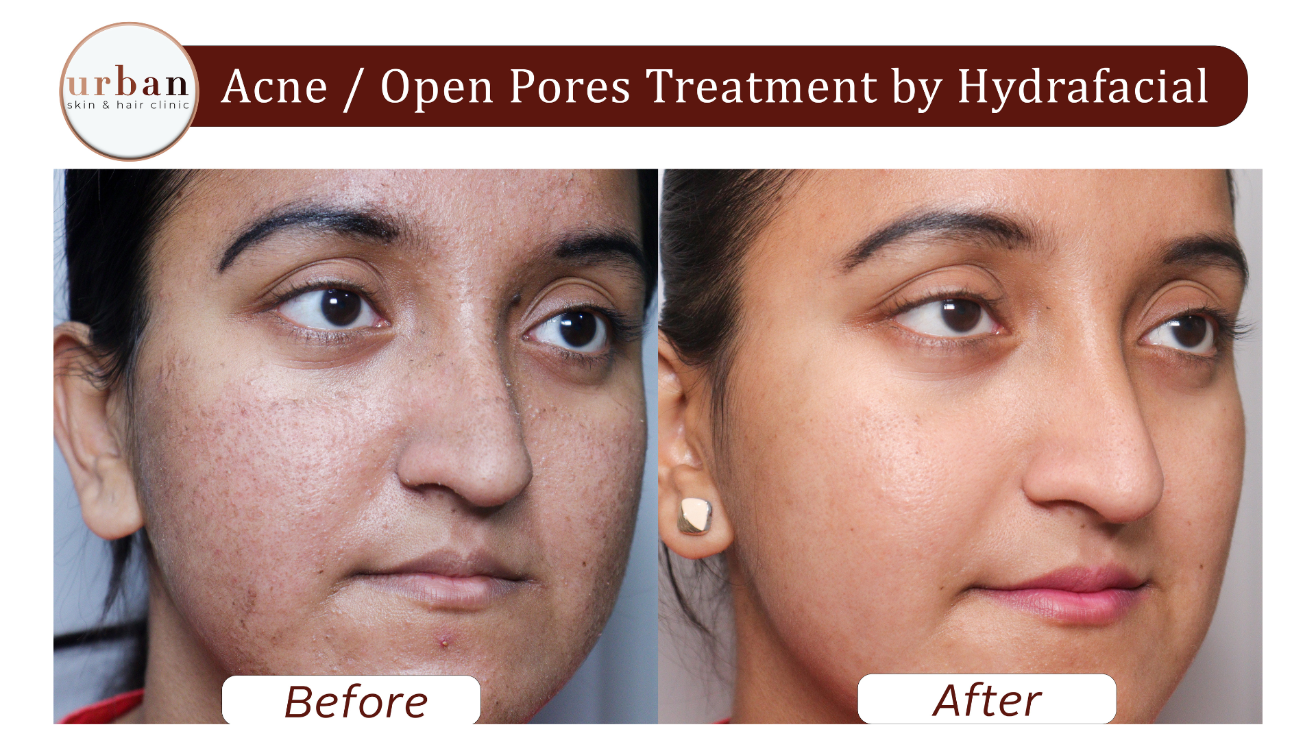 acne Open Pores treatment by Hydrafacial 5
