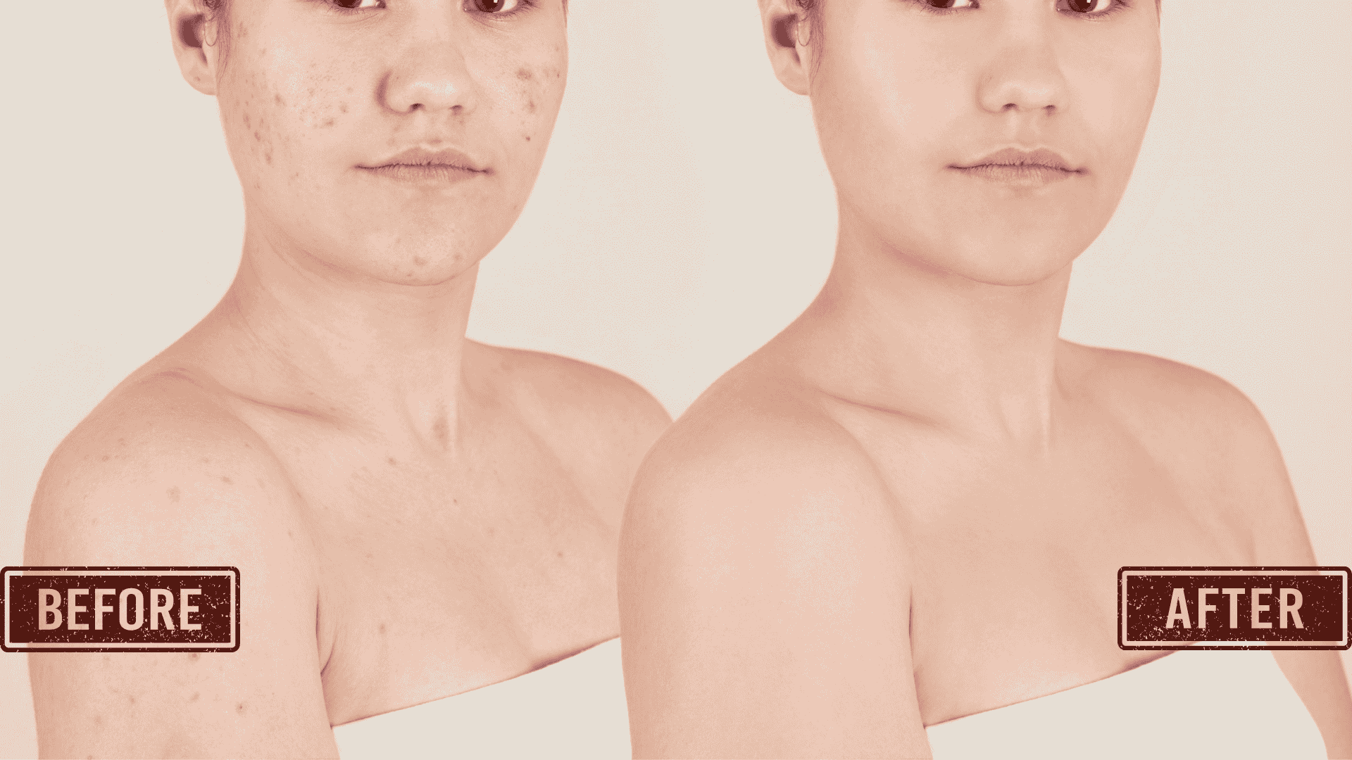 before after body acne