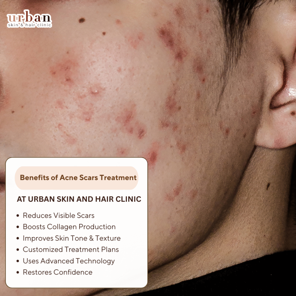 benefit of Urban treatment