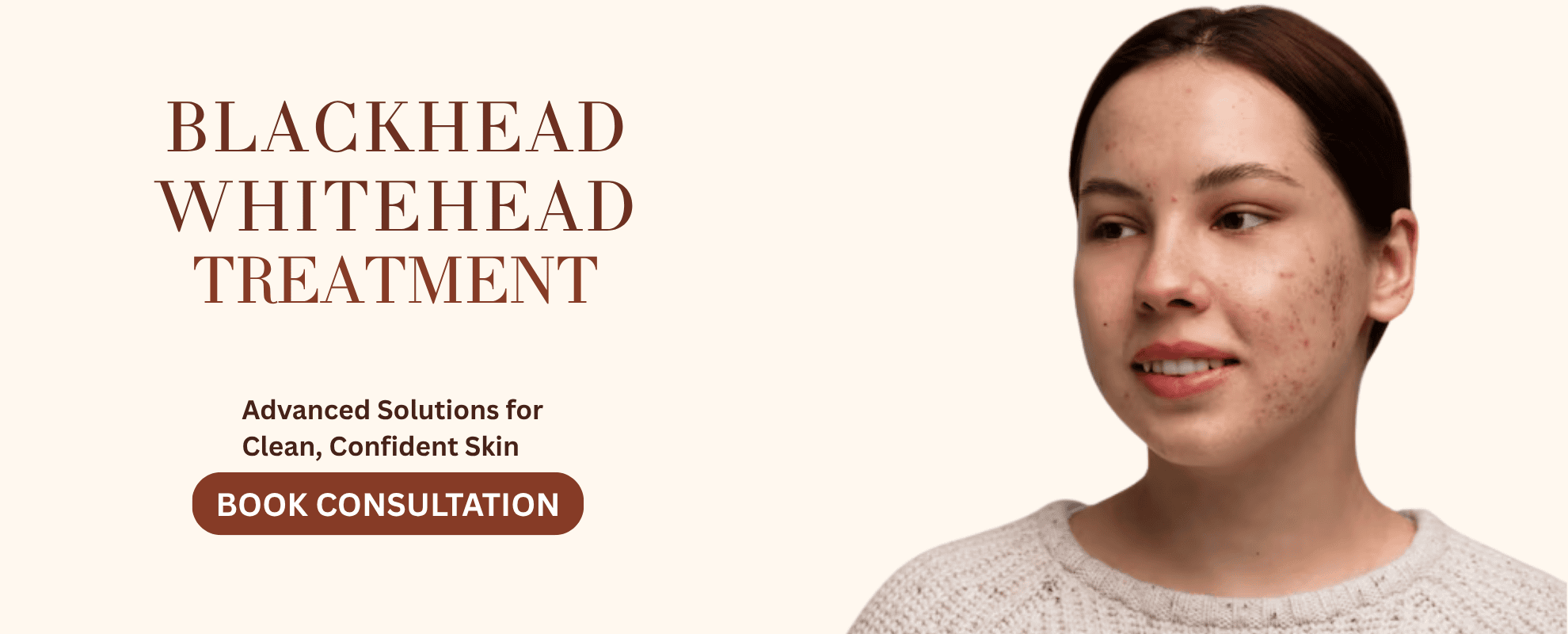 blackheads white heads treatment