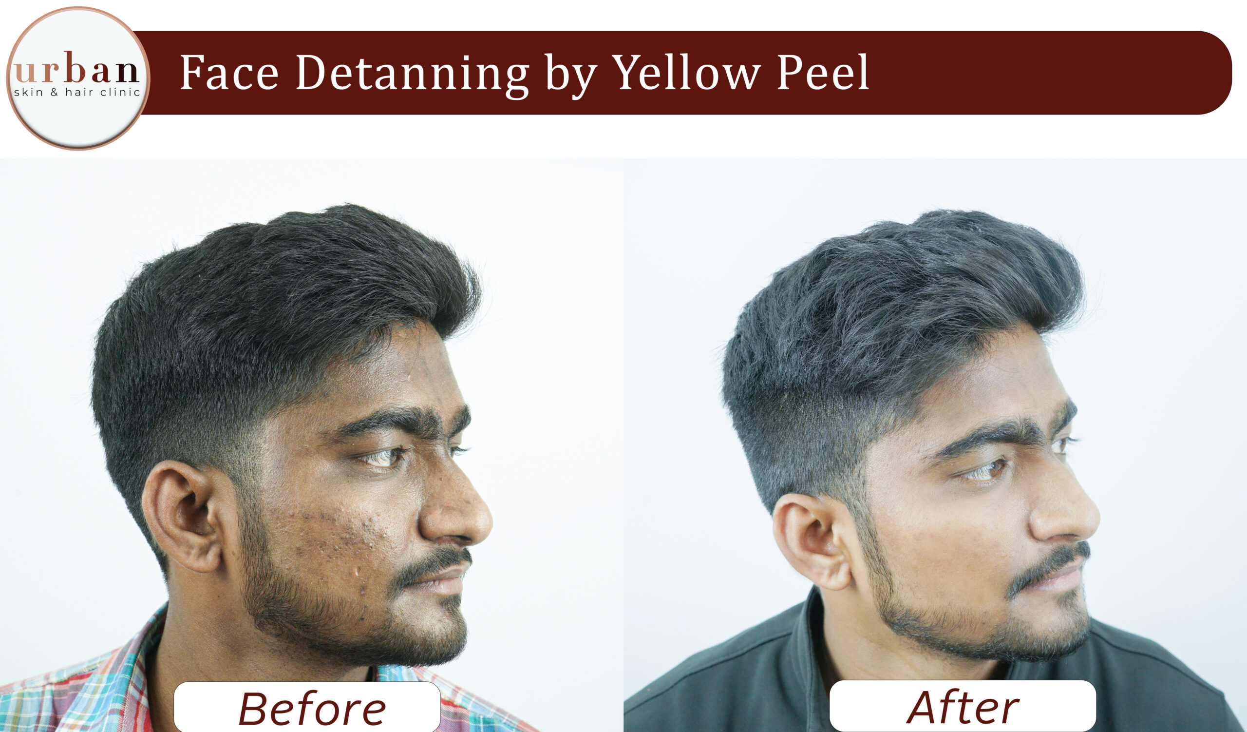 face detanning 01