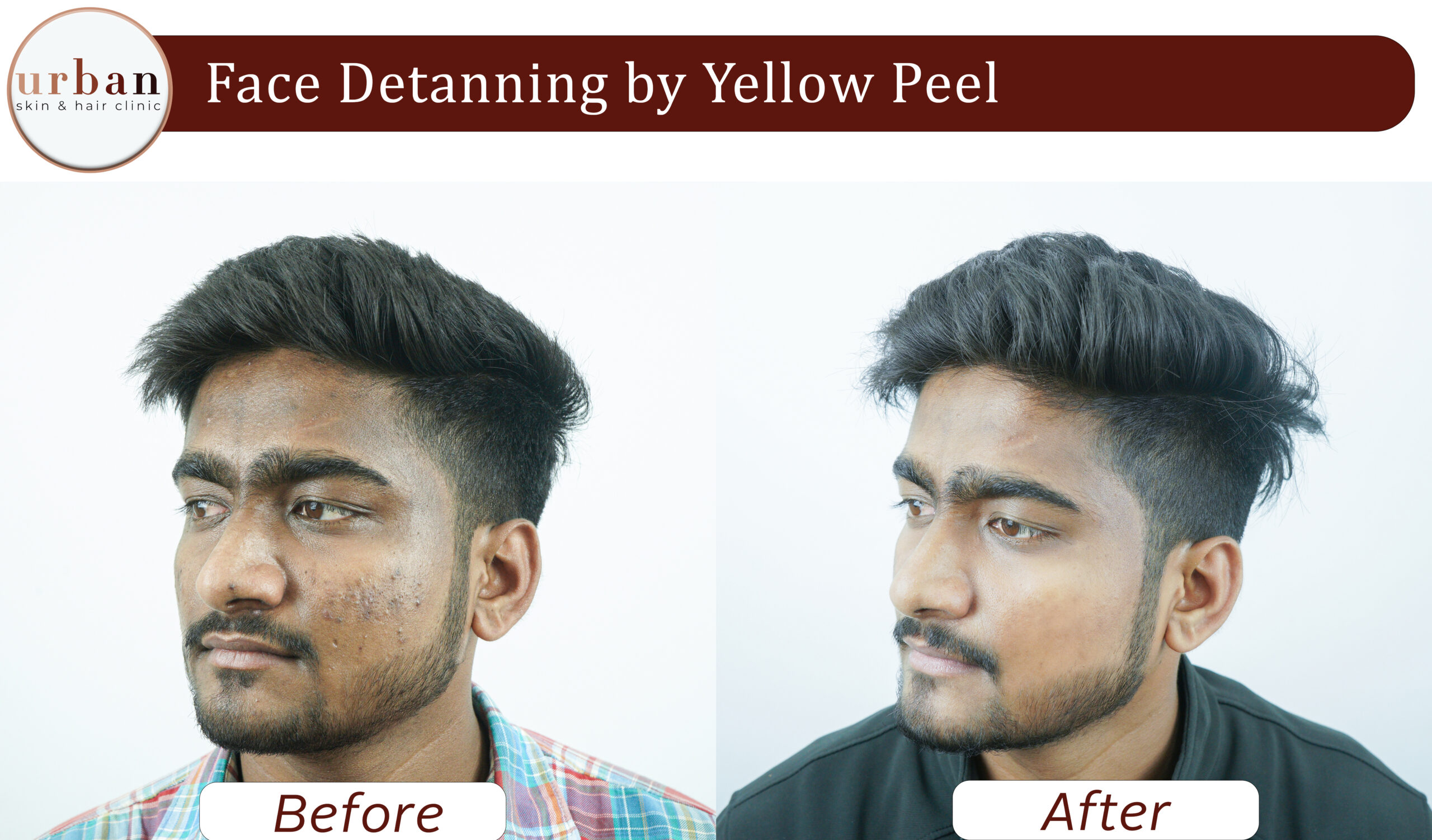 face detanning 02