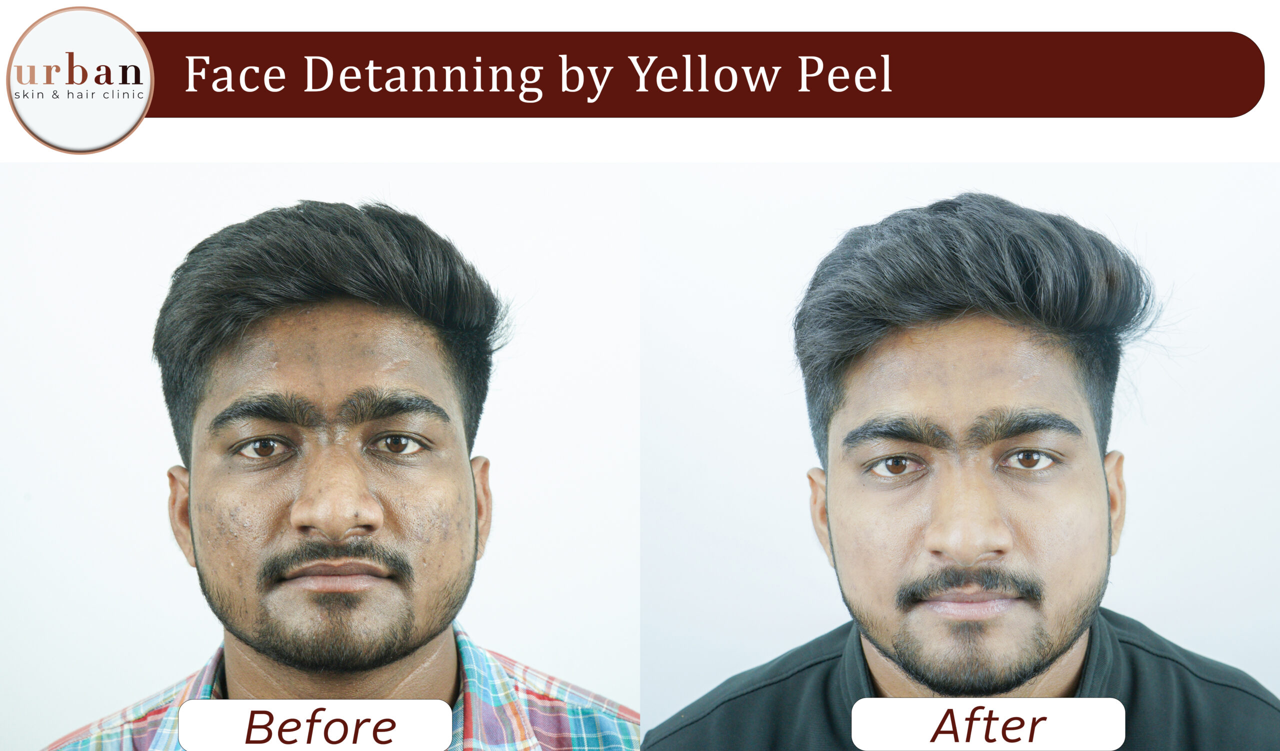 face detanning 03
