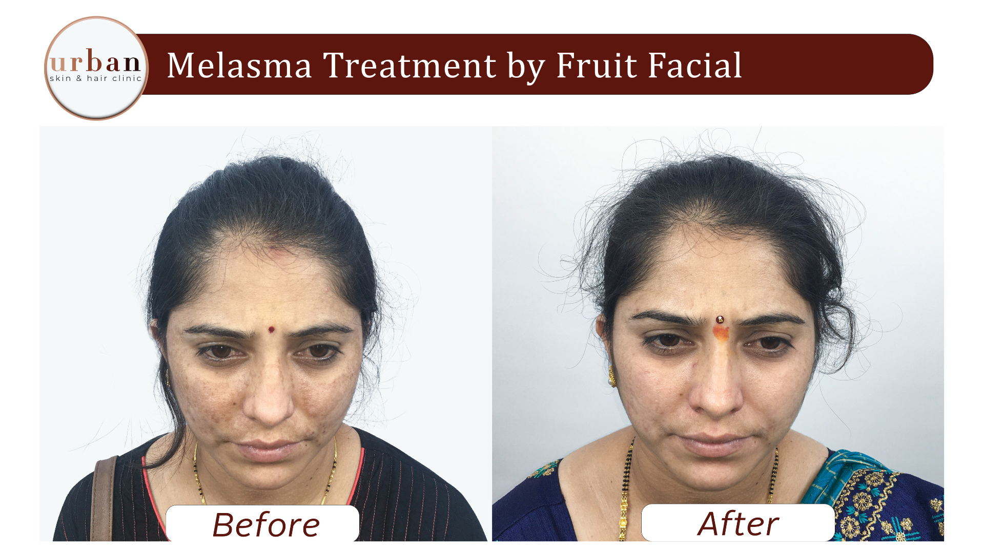 melasma treatment By Fruit Facial 1