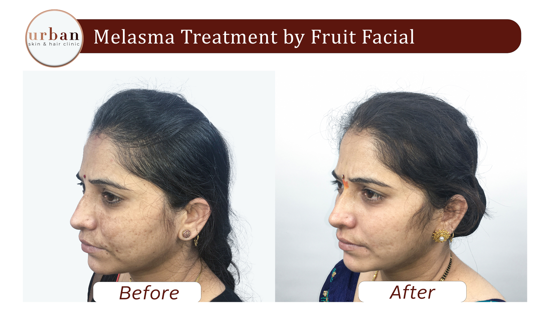 melasma treatment By Fruit Facial 2