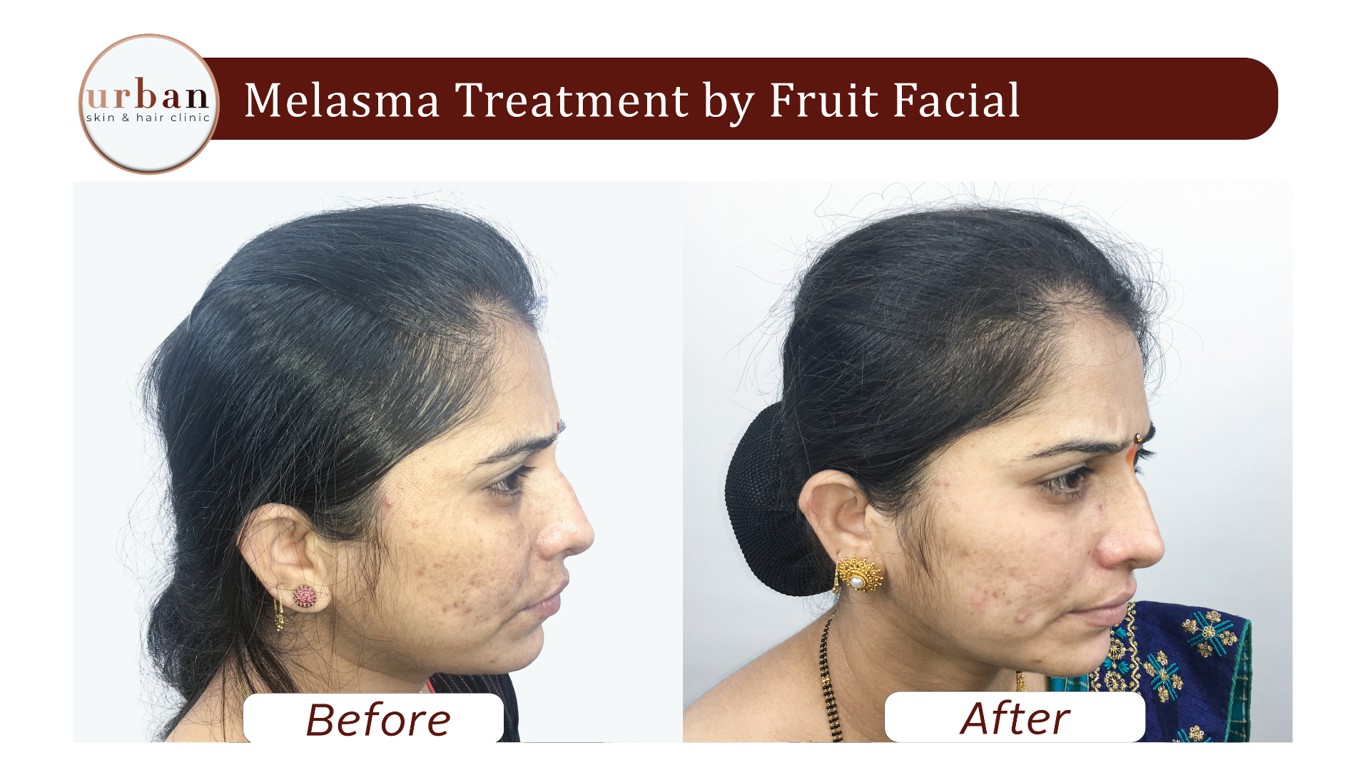 melasma treatment By Fruit Facial 3