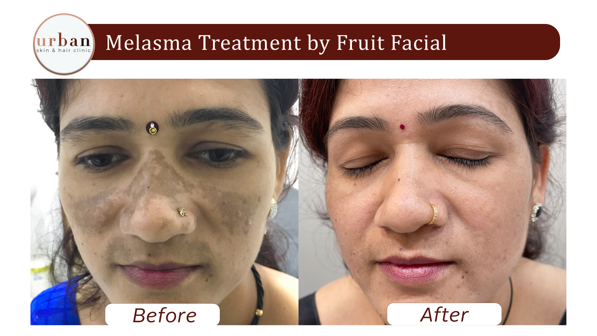 melasma treatment By Fruit Facial 4