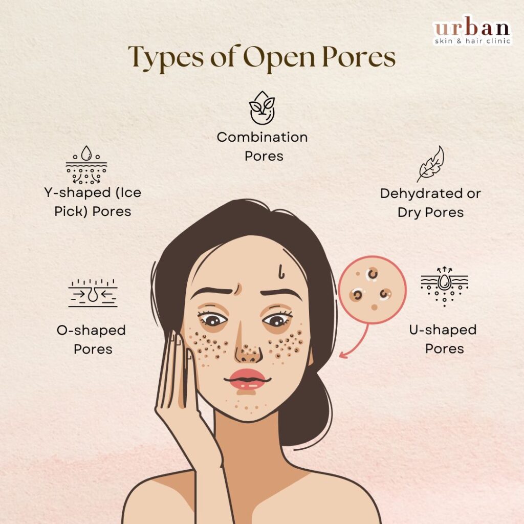 types of open pores