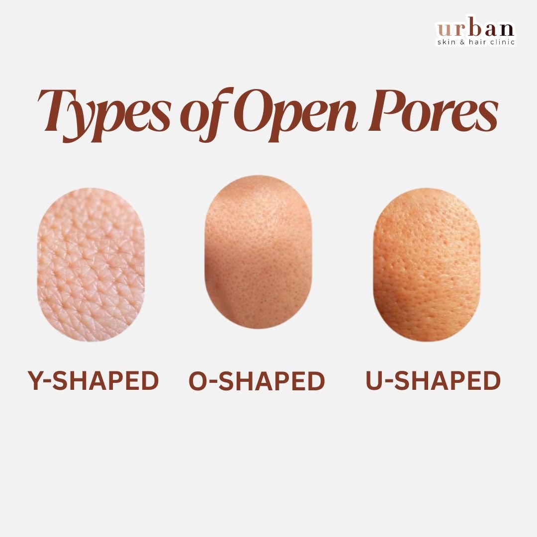 Open Pore Cyst 6 Best Open Pores Treatments In Pune | Urban Skin Care