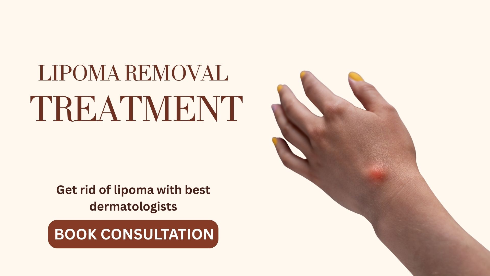 Lipoma Removal treatment 1