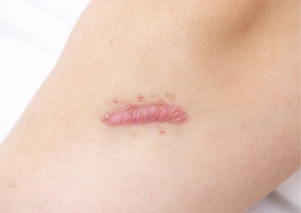 Urban website treatment 44