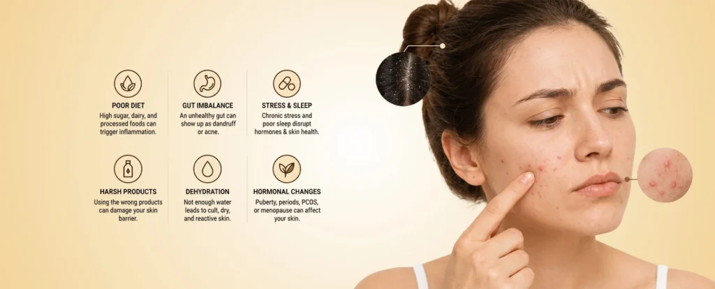 Causes of Dandruff and Acne Why You May Need Dandruff Treatment Pune