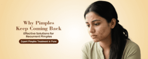 Home 50 Pimple Treatment in Pune